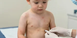 éruption cutanée enfant sans fièvre